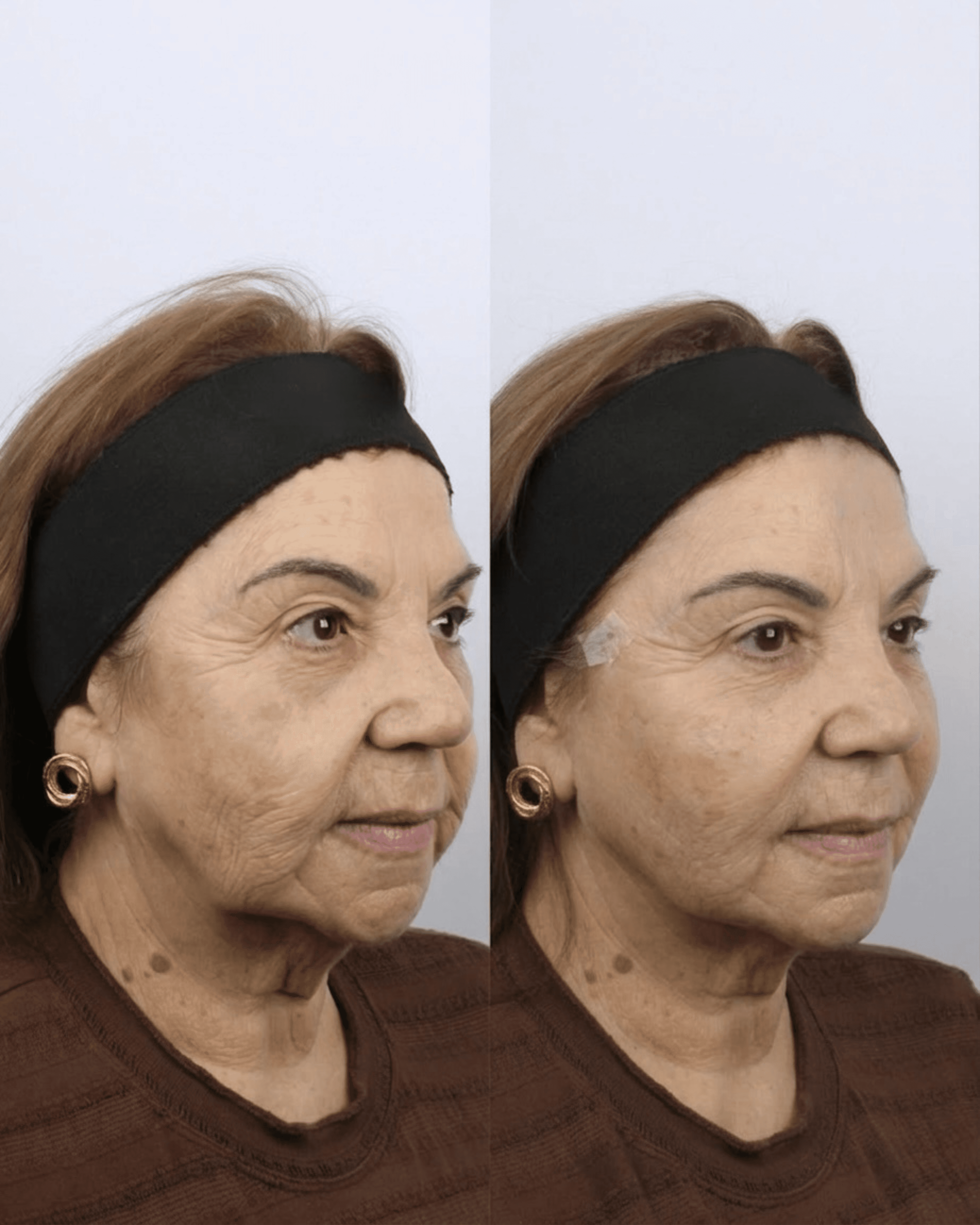 Resultado antes do procedimento